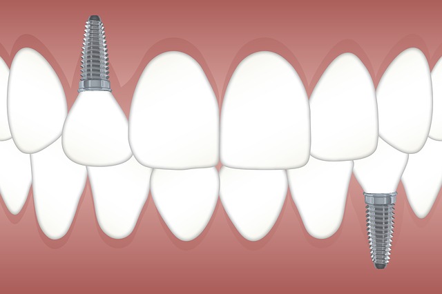 zubní implatáty